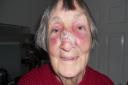 Rita Hill broke her nose in the fall in High Street, Romford.